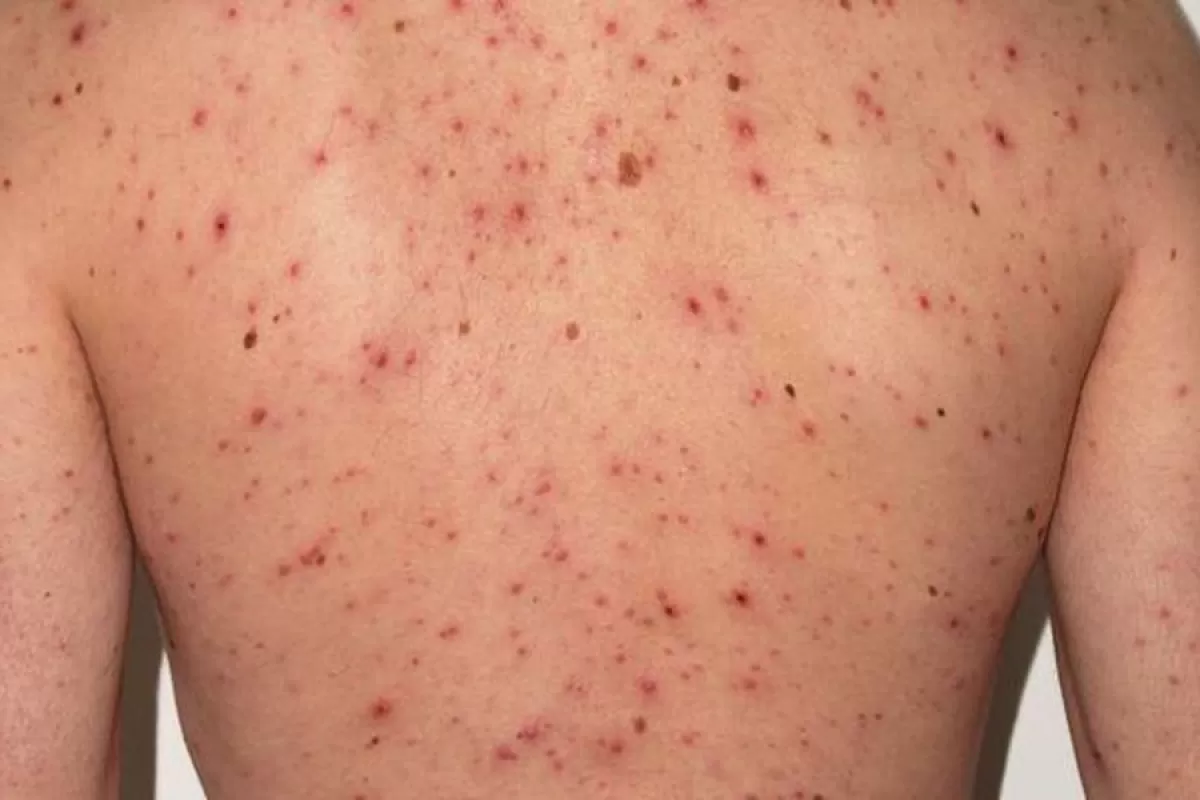 Confirmaron el primer caso de sarampi&oacute;n del a&ntilde;o y activan protocolos en Azul y Tigre