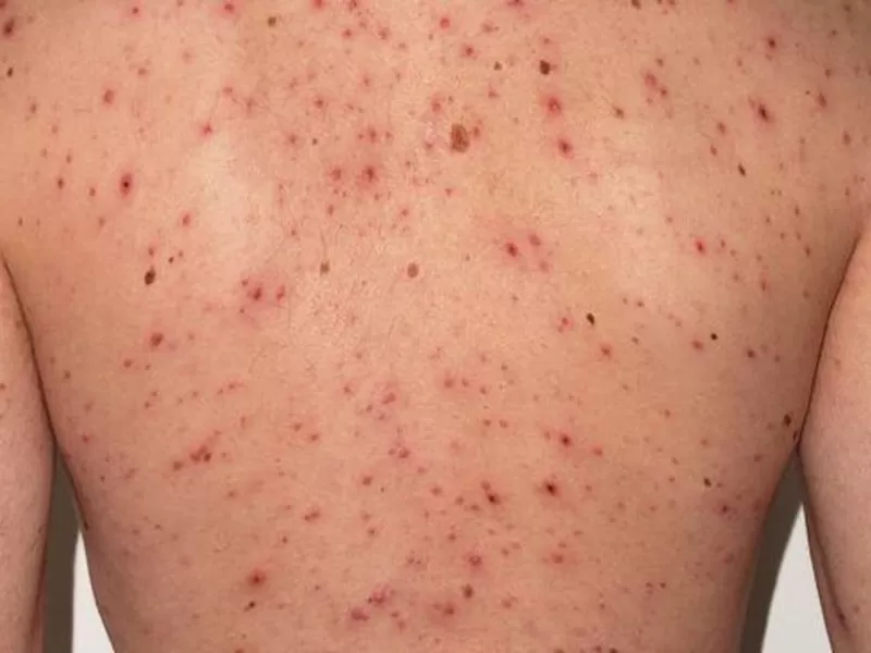 Confirmaron el primer caso de sarampi&oacute;n del a&ntilde;o y activan protocolos en Azul y Tigre